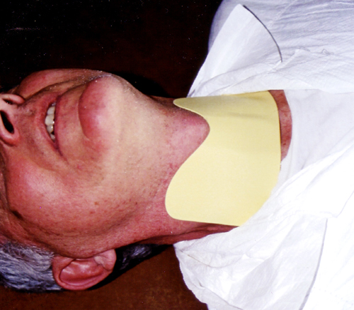 Attenurad CT Thyroid Shield